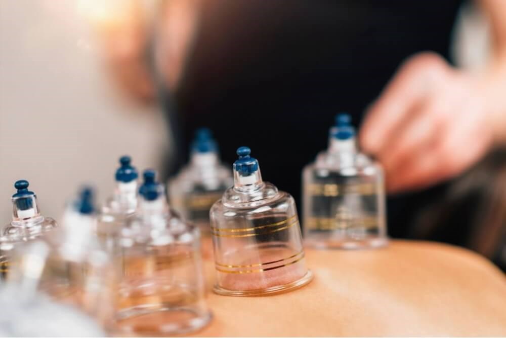 Cupping procedure